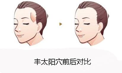 什么是自體脂肪豐太陽穴？用自體脂肪豐太陽穴的效果能維持多久？