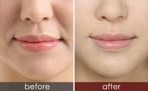 玻尿酸祛除法令紋的優(yōu)勢？玻尿酸和肉毒素祛法令紋，哪一種效果好？