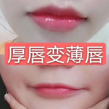 厚唇改薄整形手術(shù)價(jià)格？厚唇改薄多久完全恢復(fù)？
