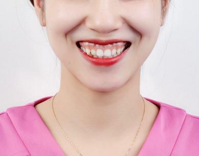 露齦笑能矯正嗎？肉毒素治療露齦笑注射量是多少？