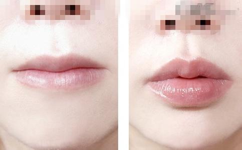 唇部綜合整形手術(shù)項(xiàng)目有哪些？唇部綜合整形多少錢(qián)？