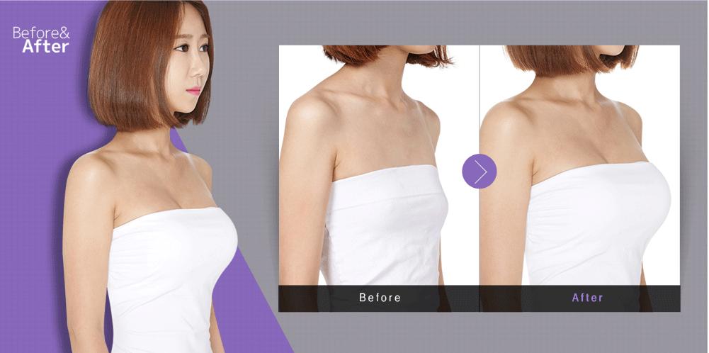 復(fù)合隆胸多少錢？復(fù)合隆胸后要注意什么？