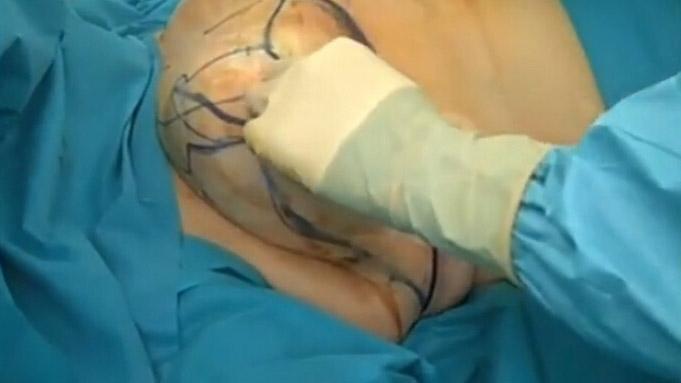 乳房縮小手術(shù)要多少錢？乳房縮小術(shù)是大手術(shù)嗎？