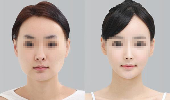 做下頜角整形手術(shù)效果好嗎？下頜角整形手術(shù)要多少錢？