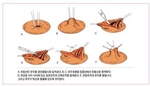 乳頭內(nèi)陷矯正手術(shù)多少錢？乳頭內(nèi)陷矯正手術(shù)多久可以恢復(fù)？