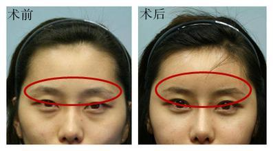 自體脂肪填充眉弓安全嗎？自體脂肪填充是永久的嗎？