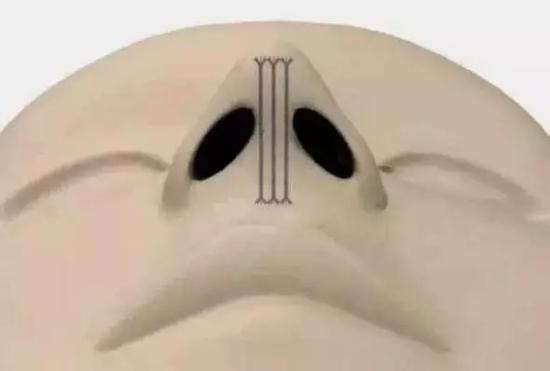 埋線手術(shù)鼻子的效果能保持多久？埋線手術(shù)鼻子術(shù)后的注意事項？