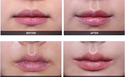 嘴角上揚(yáng)術(shù)有幾種方法？嘴角上揚(yáng)術(shù)疤痕恢復(fù)期？