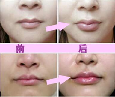 玻尿酸豐唇珠效果怎么樣？玻尿酸豐唇珠多少錢？