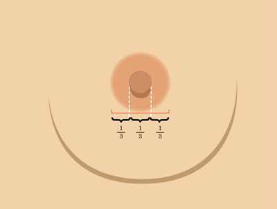 乳暈縮小如何矯正 乳暈縮小術(shù)的注意事項有哪些？