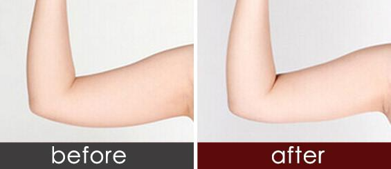 手臂抽脂效果明顯嗎 ？吸脂瘦手臂會(huì)反彈嗎？