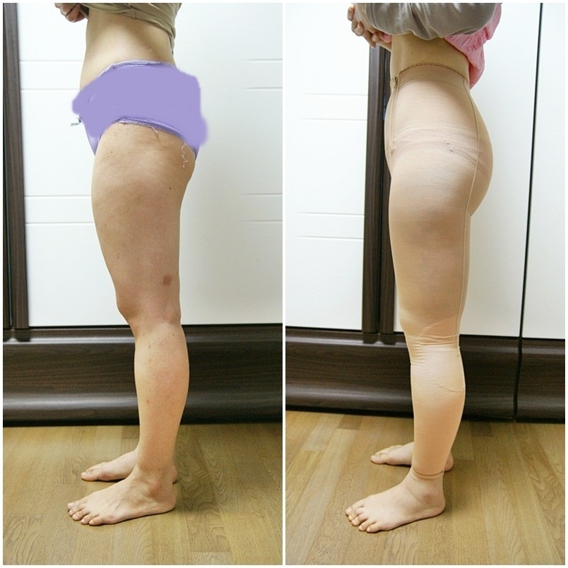 吸脂瘦大腿腫脹期是多久？大腿吸脂有什么后遺癥嗎？