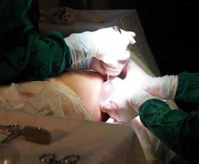 胸部假體取出多久可以重新做 ？胸部假體取出注意事項(xiàng)？