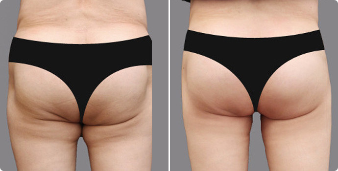 吸脂瘦臀部?jī)r(jià)格多少？吸脂瘦臀術(shù)后如何護(hù)理？