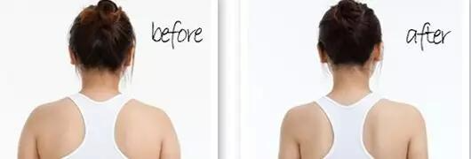 后背抽脂那些人可以做？吸脂瘦肩膀多少錢(qián)？