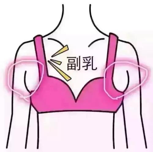 吸脂做副乳要多少錢？吸脂去副乳會反彈嗎？