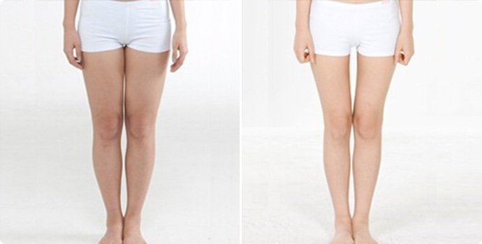 冷凍溶脂瘦大腿如何護(hù)理 冷凍溶脂瘦大腿為什么反彈