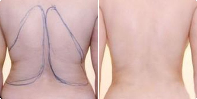 射頻溶脂瘦后背術(shù)多少錢(qián) 射頻溶脂瘦后背術(shù)后需要注意什么