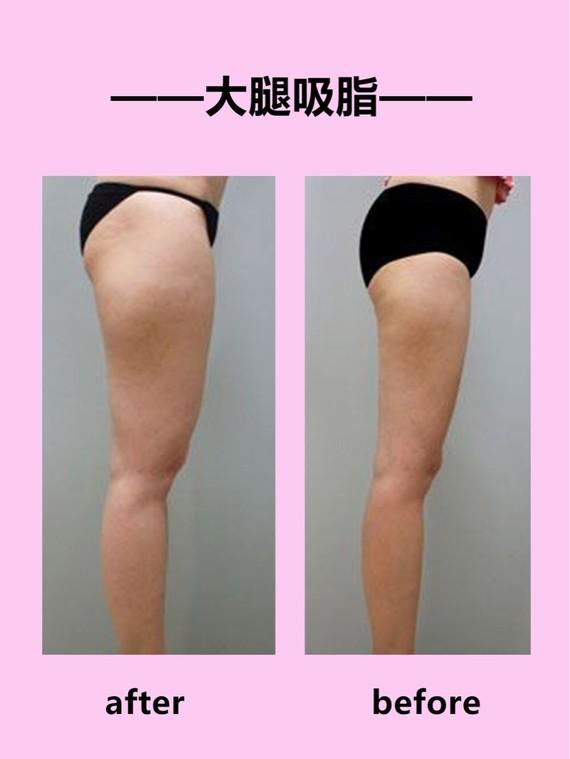 吸脂瘦大腿腫脹期是多久？大腿吸脂有什么后遺癥嗎？
