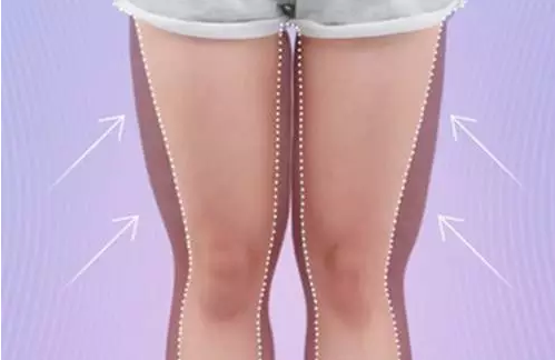 水動力吸脂會反彈嗎 水動力吸脂恢復期多久