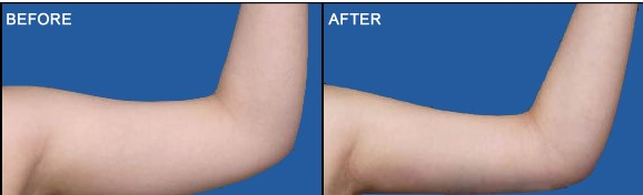 什么是冷凍脂肪減肥 冷凍溶脂瘦手臂效果如何