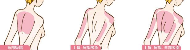 超聲溶脂瘦肩部為什么沒有效果  超聲溶脂瘦肩部有缺點嗎 