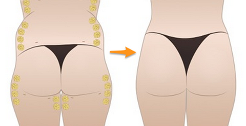 自體脂肪豐臀后會(huì)不會(huì)變形呢？自體脂肪豐臀的優(yōu)缺點(diǎn)有哪些？
