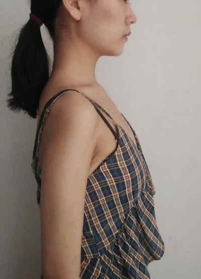 隆胸手術(shù)前上海藝星醫(yī)療美容醫(yī)院做隆胸手術(shù)前