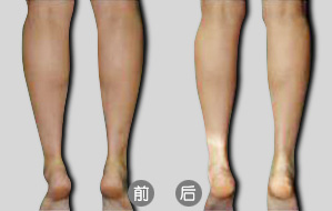 隔空溶脂瘦小腿后如何術后護理  隔空溶脂瘦小腿多少錢