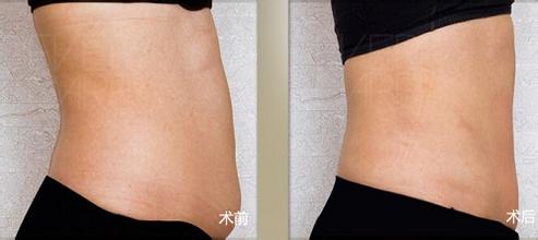 隔空溶脂瘦腹部手術(shù)有什么風(fēng)險  隔空溶脂瘦腹部多少錢