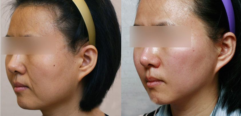 熱瑪吉做一次可以保持多久？熱瑪吉的原理和功效