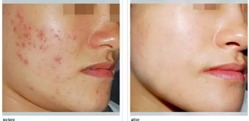 皮秒激光一般可以做幾次有效果  皮秒激光有哪些優(yōu)勢