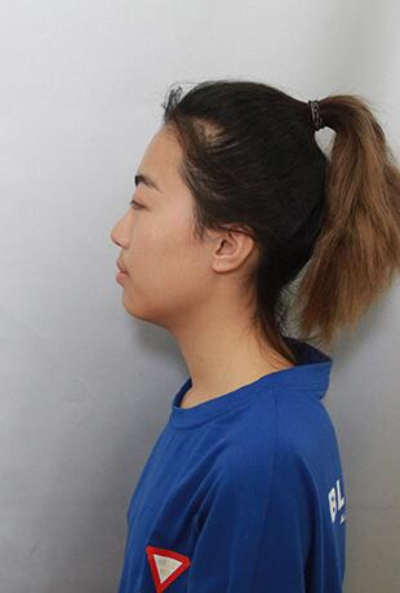 上海美萊醫(yī)療美容門診部白承燦隆胸案例效果分享