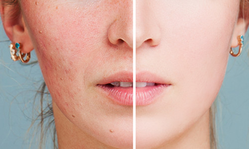 北京阿露絲醫(yī)療美容怎么樣？紅藍(lán)光祛痘紅藍(lán)光有何區(qū)別？