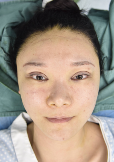 寧波尚美整形美容醫(yī)院做雙眼皮手術(shù)剛做完后 寧波尚美整形美容醫(yī)院做雙眼皮手術(shù)剛做完后