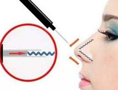 成都博雅整形埋線隆鼻有哪些優(yōu)勢(shì)？成都博雅埋線隆鼻疼嗎？