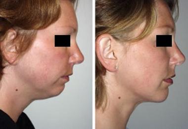 成都當代整形透明質(zhì)酸墊下巴效果？ 透明質(zhì)酸墊下巴多少錢？