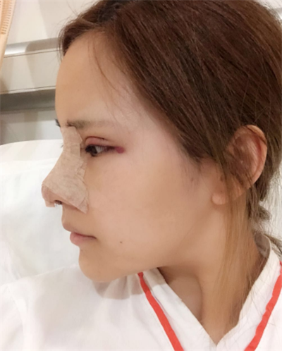 深圳弘美醫(yī)療美容門診部丁芷林眼綜合案例效果分享