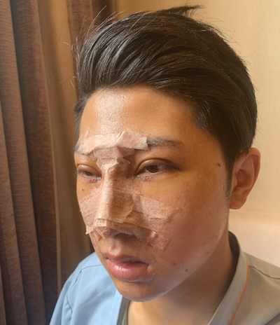 長春中妍醫(yī)療美容醫(yī)院吳學軍鼻綜合案例效果分享