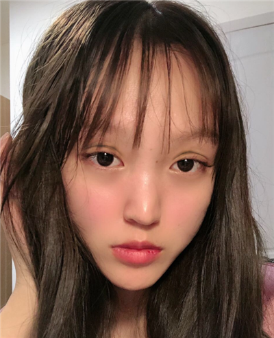 慈溪悅爾醫(yī)學(xué)美容醫(yī)院做雙眼皮術(shù)后眼睛還未完全消腫