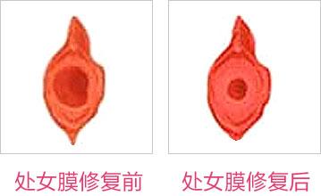 成都東方整形處女膜修復(fù)怎么樣？處女膜修復(fù)術(shù)后如何護(hù)理？