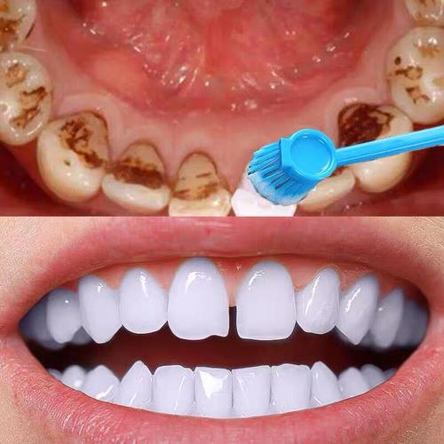 y安徽天鵝湖口腔烤瓷牙種類有哪些?安徽天鵝湖烤瓷牙如何美白