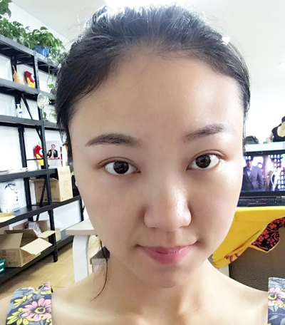 蘇州同濟(jì)醫(yī)院整形美容中心做去眼袋手術(shù)后的眼部狀態(tài)