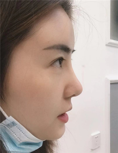 煙臺(tái)壹美整形美容醫(yī)院楊彪炳隆鼻案例效果分享