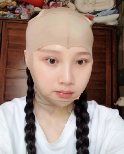 鄭州麗天整形美容醫(yī)院做面部吸脂手術(shù)后的情形