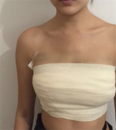  寧波珈禾整形?？漆t(yī)院雷中元隆胸案例效果分享