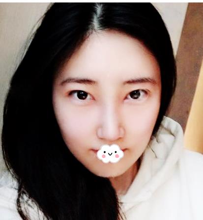 長春亞韓整形假體隆鼻案例術(shù)后三個月 長春亞韓整形假體隆鼻案例術(shù)后三個月