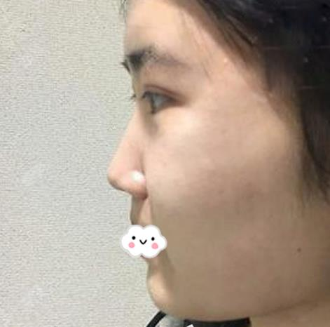 假體隆鼻假嗎？假體隆鼻三個月效果分享