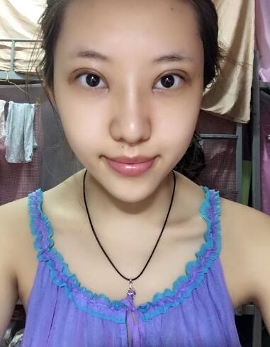 第四軍醫(yī)大學(xué)唐都醫(yī)院李望舟雙眼皮案例術(shù)后一個(gè)月