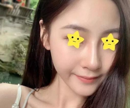 做綜合鼻，上海首爾麗格安建榮鼻綜合真人案例照片